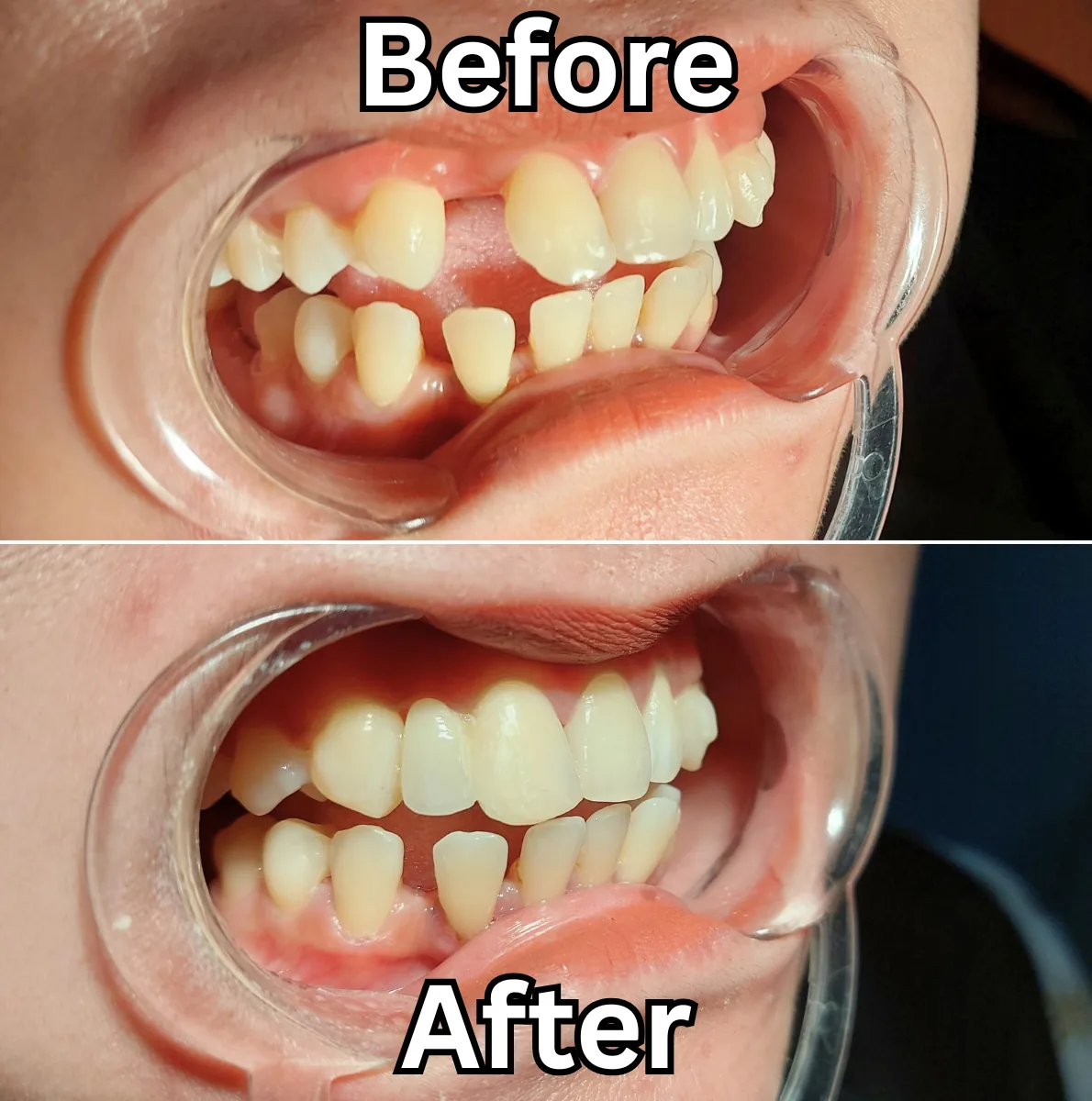 Before after perawatan gigi palsu