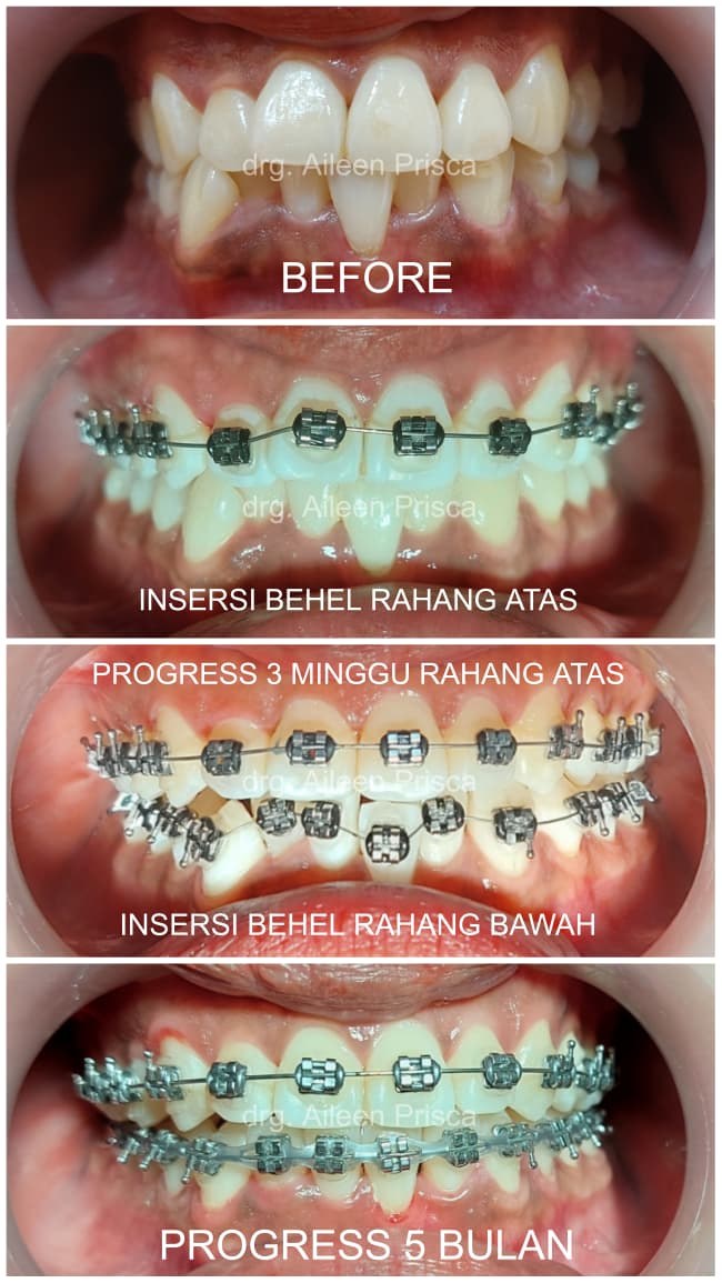Progress perawatan behel