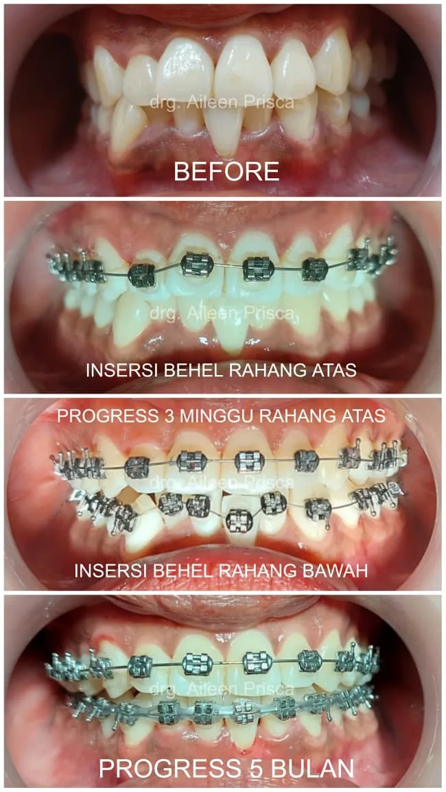 Progress perawatan behel