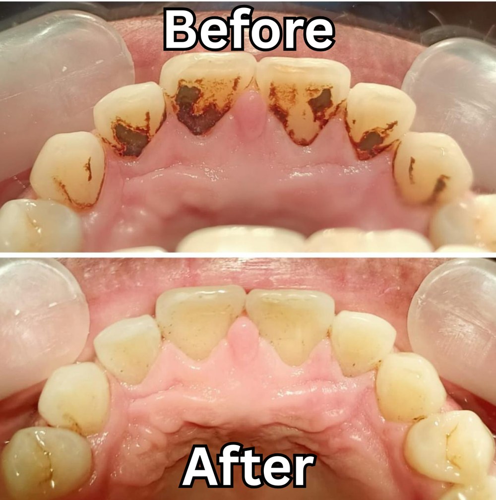 Before after scaling karang gigi